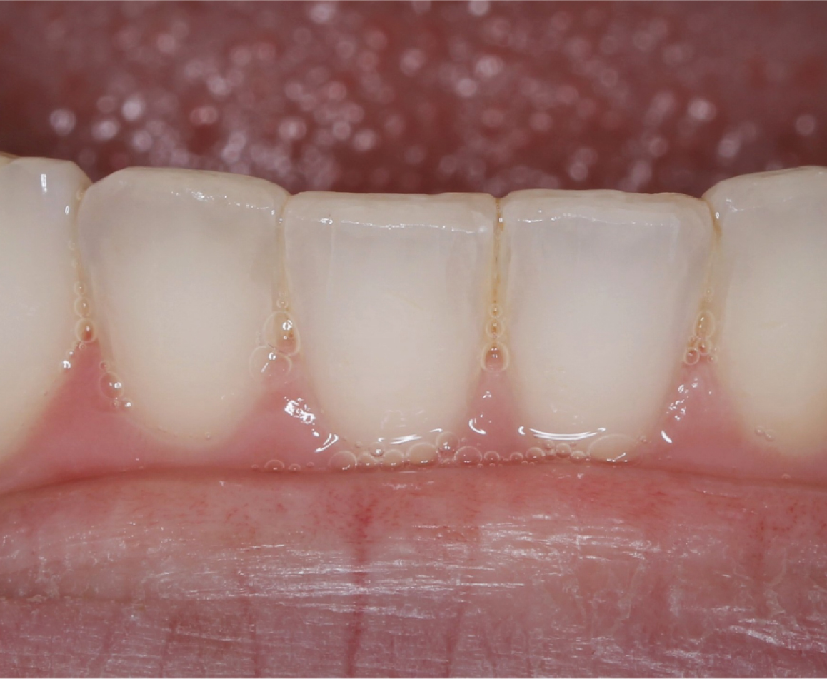 After image