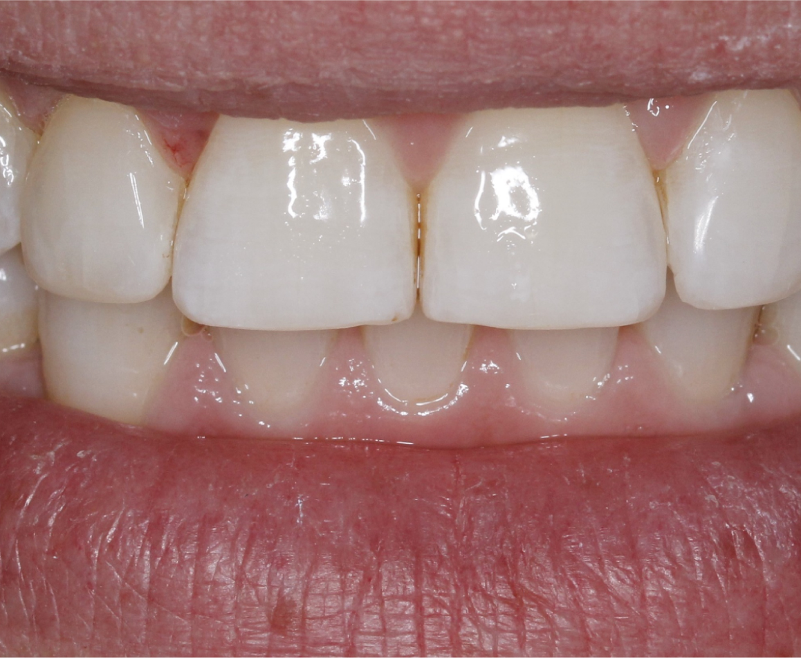 After image